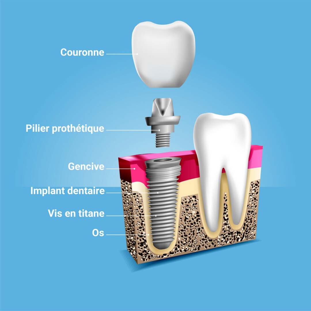 implant dentaire a tanger chez Dr Razzak Achouak Dentiste Orthodontiste Tanger