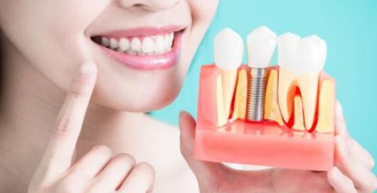 prix implant dentaire a tanger chez Dr Razzak Achouak Dentiste Orthodontiste Tanger